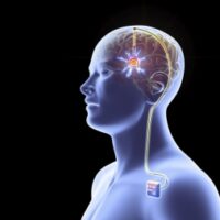 La Stimolazione Cerebrale Profonda (Deep Brain Stimulation) nella Malattia di Parkinson